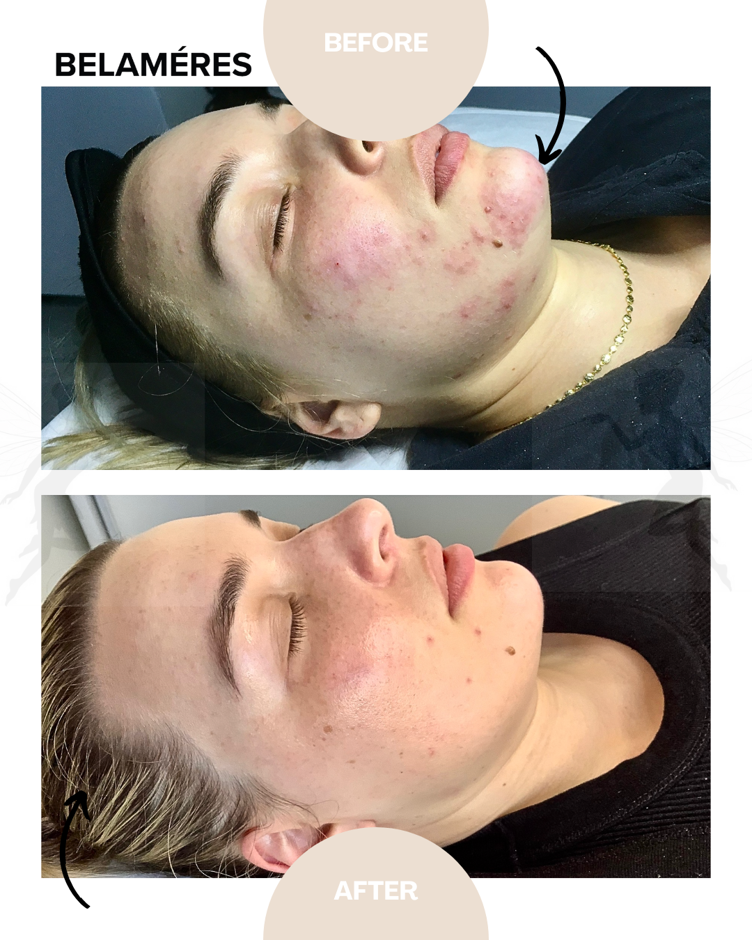 Sleeping Fairy Treatment