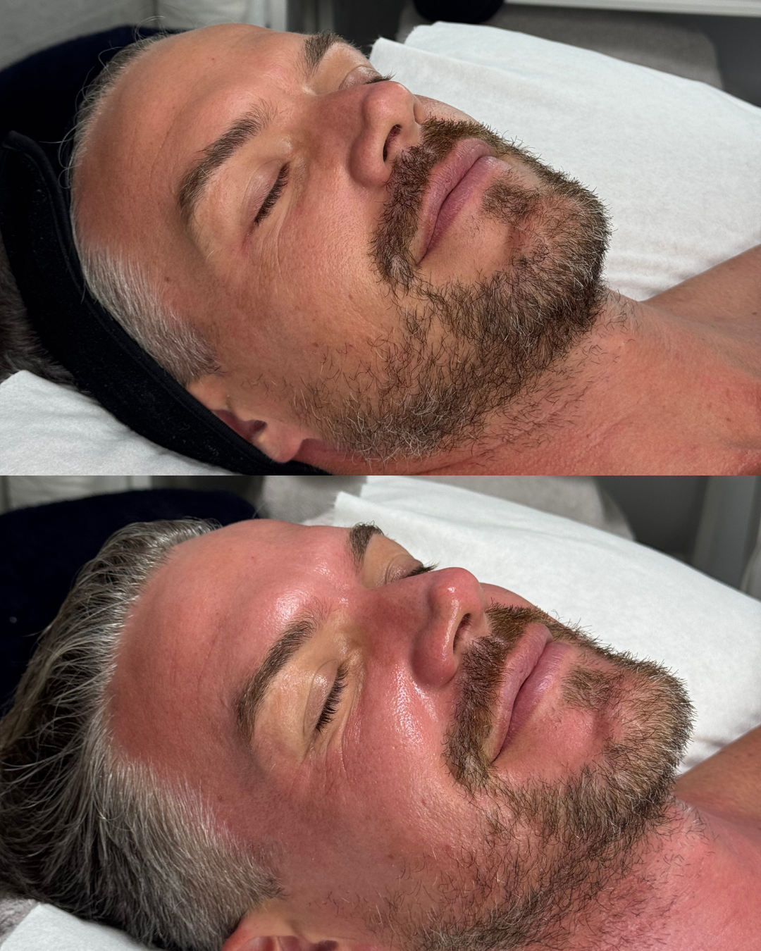 Before after skin treatment tired skin