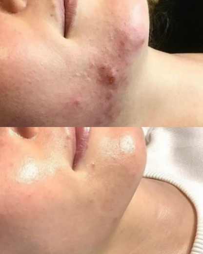 Skin treatment Acne-prone skin