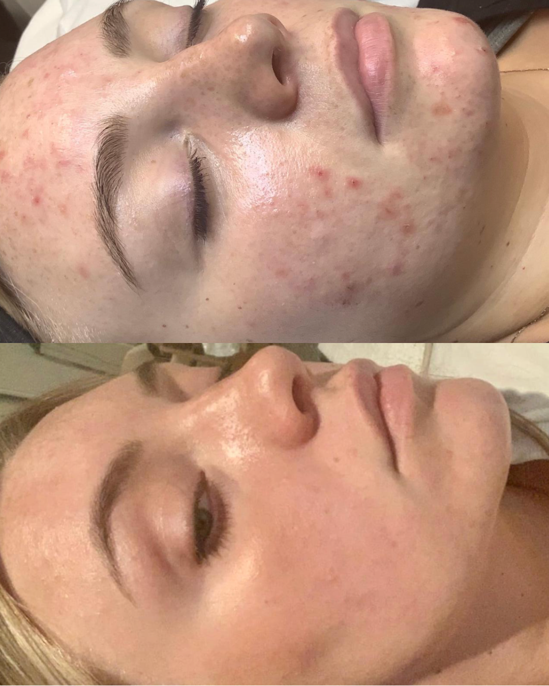 Skin Treatment acne skin