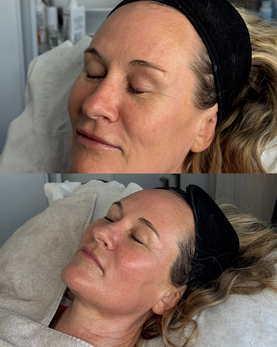 Before after skin treatment anti-ageing