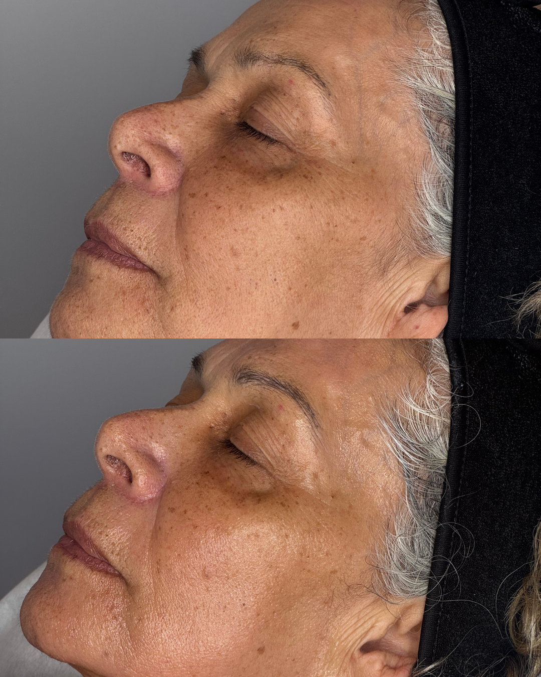Before after skin treatment anti-ageing