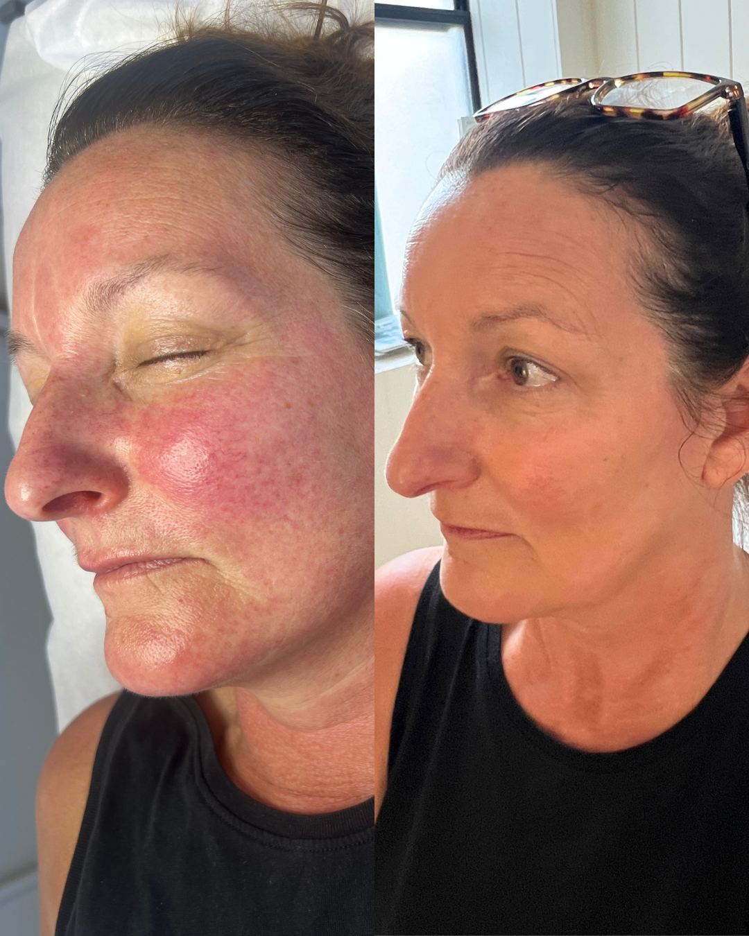 Before and after redness-calming results from Fairy Skin by Epicutis at Belaméres