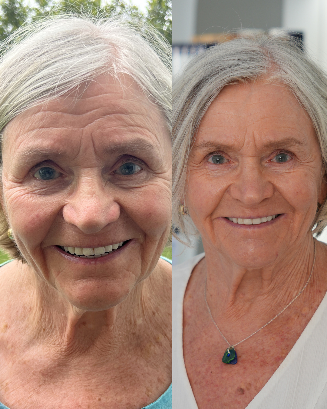 INDIBA Face & Neck - Belameres