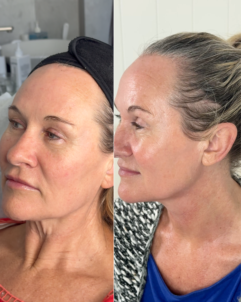 INDIBA Face & Neck - Belameres